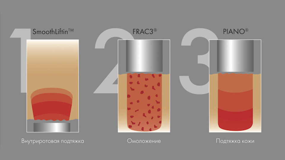 Fotona® 3Д комплексная лазерная методика омоложения