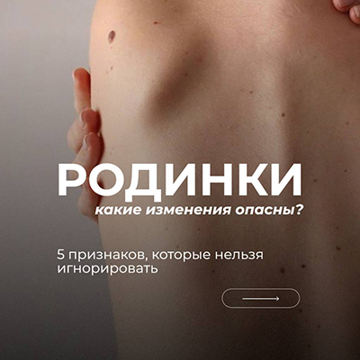 Родинки: какие изменения опасны