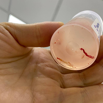 Трепан-биопсия в маммологии