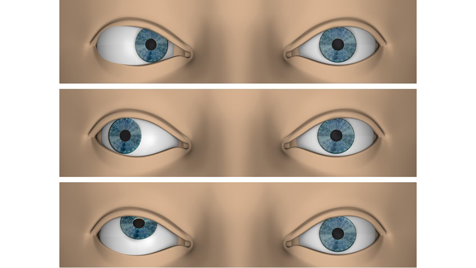 Косоглазие (страбизм) 