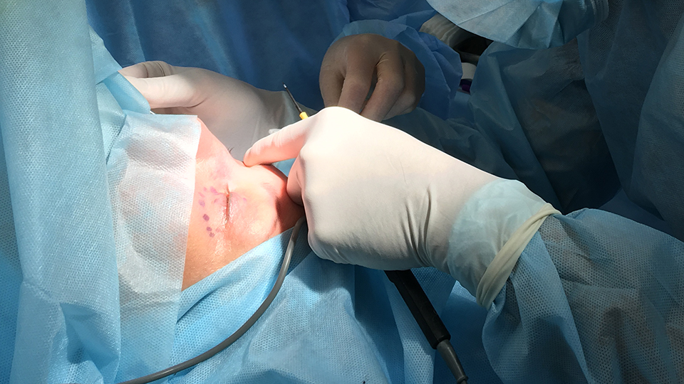 Пластика век