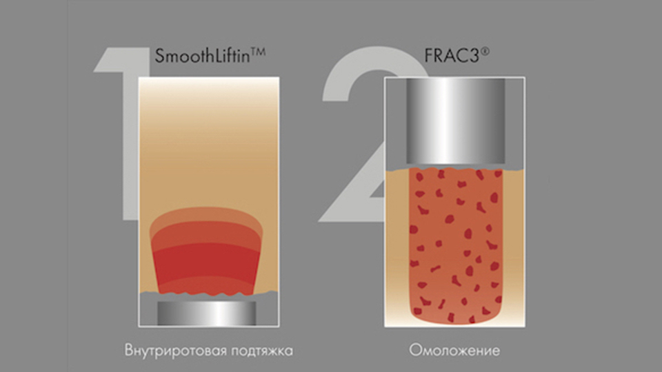 Fotona® 3Д комплексная лазерная методика омоложения