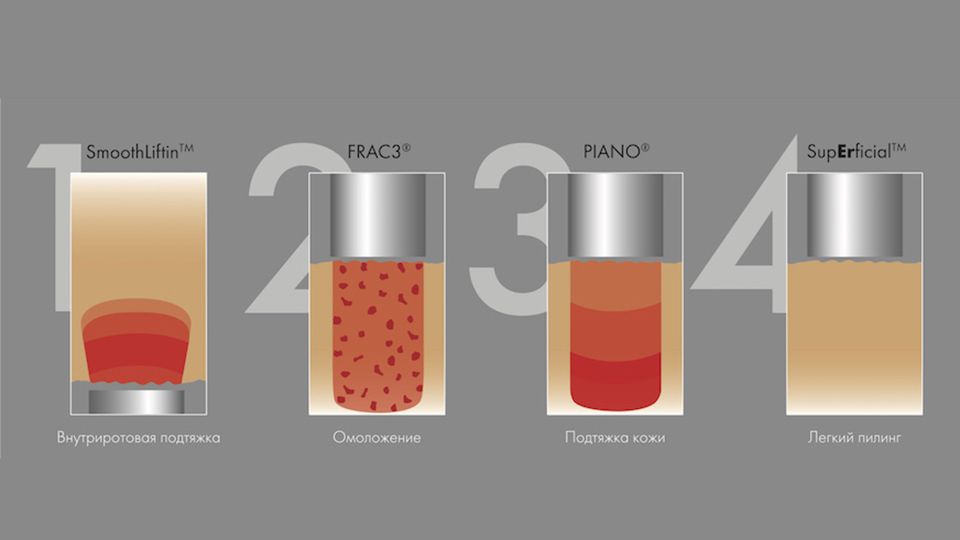 Многоуровневое омоложение и фототермическая реконструкция кожи&nbsp;Fotona4Д®
